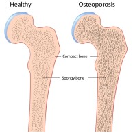 Efek buruk osteoporosis bagi tubuh